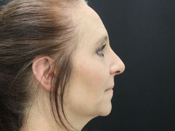 Rhinoplasty Case 3 - After