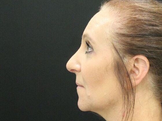 Rhinoplasty: Case 3 - After