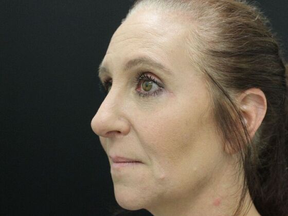 Rhinoplasty: Case 3 - After