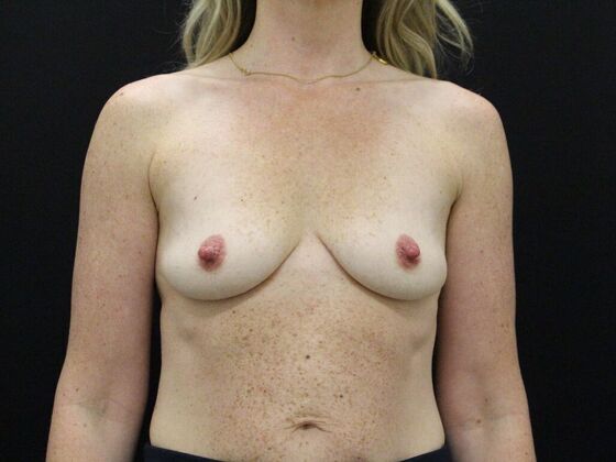 Breast Augmentation Case 39 - Before