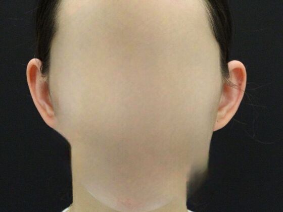 Otoplasty: Case 3 - Before