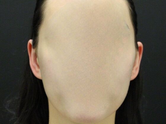 Otoplasty: Case 3 - After