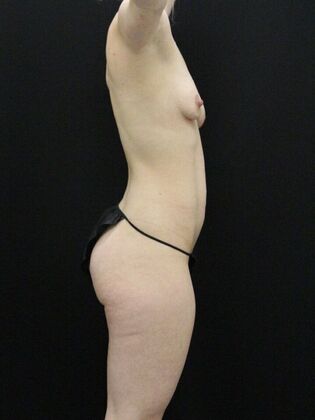 Tummy Tuck: Case 57 - Before