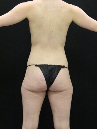 Tummy Tuck: Case 57 - Before