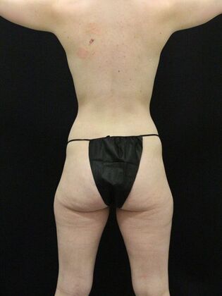 Tummy Tuck: Case 57 - After