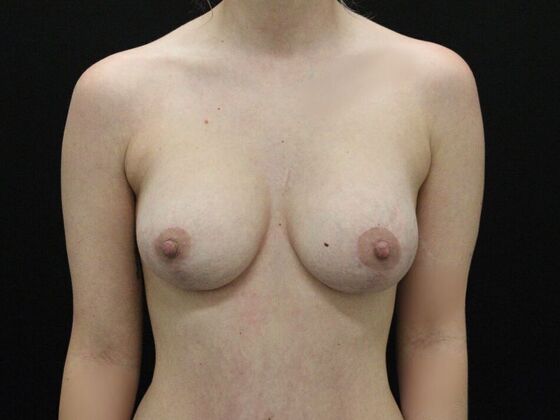 Breast Lift & Breast Lift Augmentation Case 39 - After