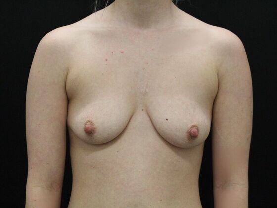 Breast Lift & Breast Lift Augmentation Case 39 - Before