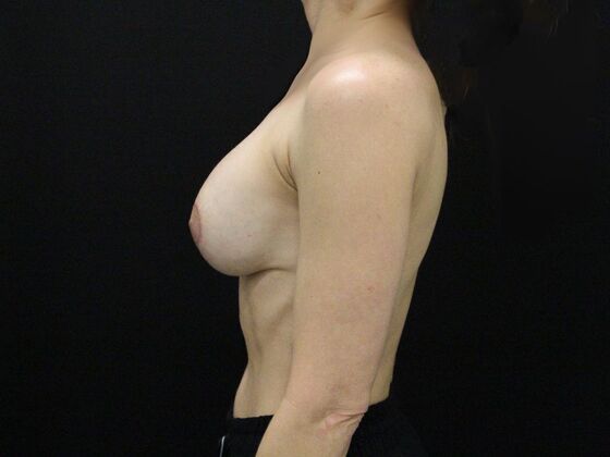 Breast Lift & Breast Lift Augmentation: Case 40 - After
