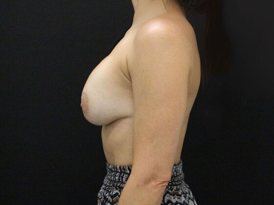 Breast Lift & Breast Lift Augmentation: Case 40 - Before