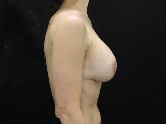 Breast Lift & Breast Lift Augmentation: Case 40 - After