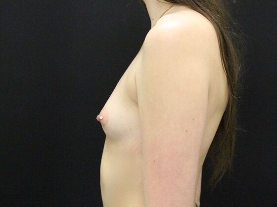 Breast Augmentation: Case 40 - Before