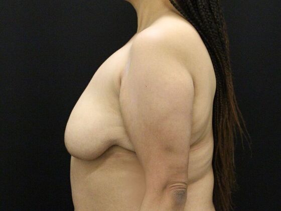 Breast Reduction & Lift: Case 27 - Before