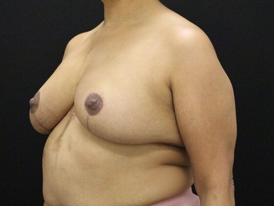 Breast Reduction & Lift: Case 27 - After