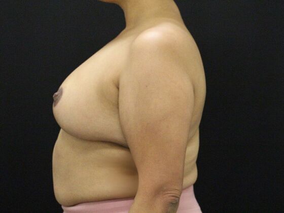 Breast Reduction & Lift: Case 27 - After