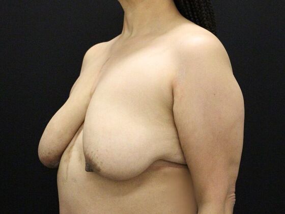 Breast Reduction & Lift: Case 27 - Before
