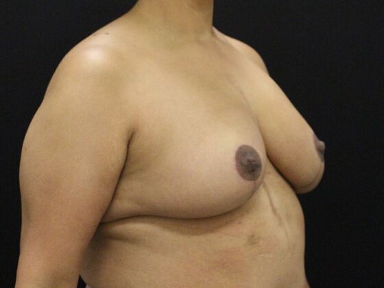 Breast Reduction & Lift: Case 27 - After