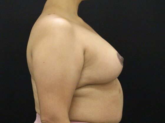 Breast Reduction & Lift: Case 27 - After