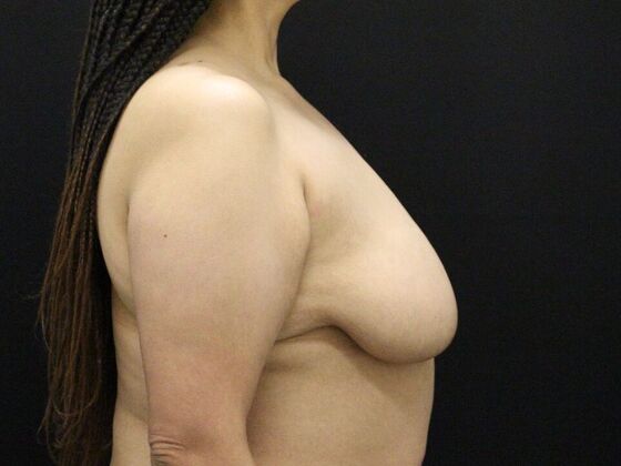 Breast Reduction & Lift: Case 27 - Before