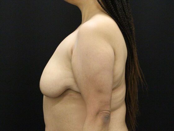 Breast Lift & Breast Lift Augmentation: Case 42 - Before