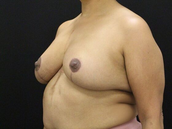 Breast Lift & Breast Lift Augmentation: Case 42 - After