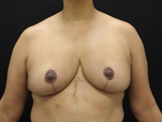 Breast Lift & Breast Lift Augmentation Case 42 - After