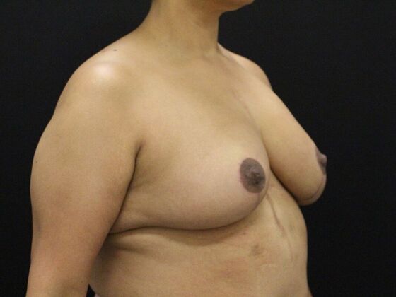 Breast Lift & Breast Lift Augmentation: Case 42 - After