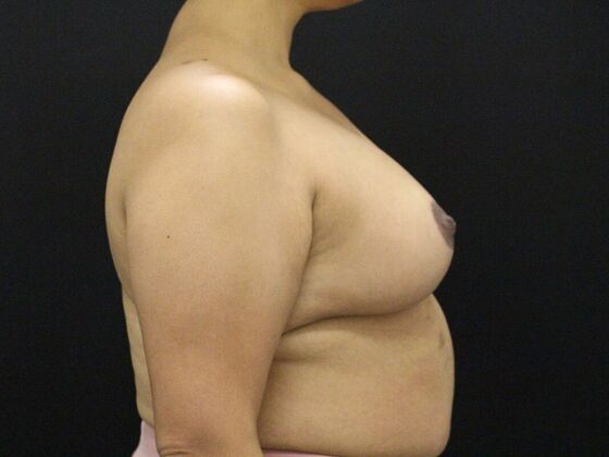 Breast Lift & Breast Lift Augmentation: Case 42 - After