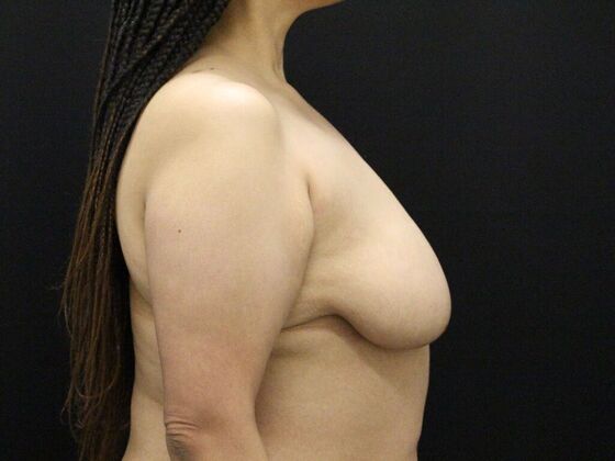 Breast Lift & Breast Lift Augmentation: Case 42 - Before