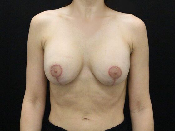 Breast Revision Case 12 - After