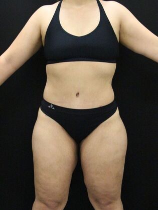Tummy Tuck Case 58 - After
