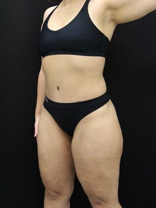 Tummy Tuck: Case 58 - After