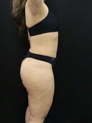 Tummy Tuck: Case 58 - After