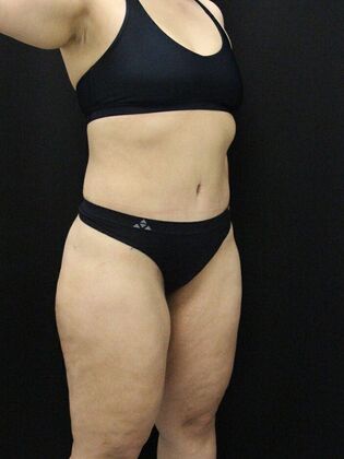 Tummy Tuck: Case 58 - After