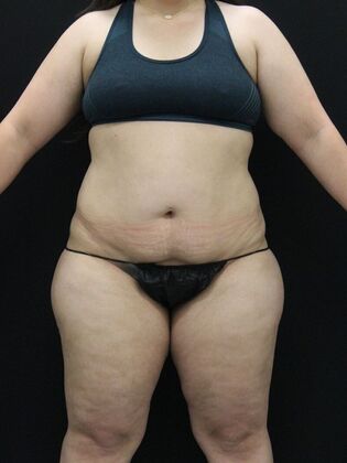 Tummy Tuck Case 58 - Before