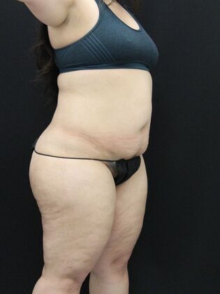 Tummy Tuck: Case 58 - Before