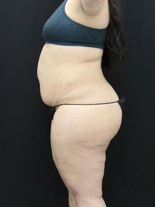 Tummy Tuck: Case 58 - Before