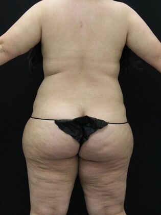 Tummy Tuck: Case 58 - Before