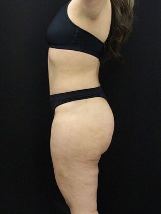 Tummy Tuck: Case 58 - After