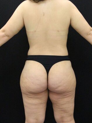 Tummy Tuck: Case 58 - After