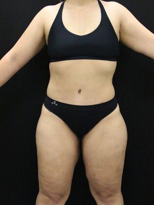 Liposuction: Case 48 - After