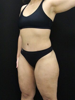 Liposuction: Case 48 - After