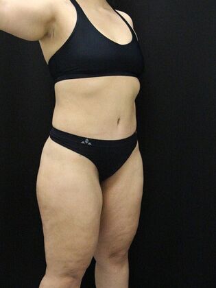 Liposuction: Case 48 - After