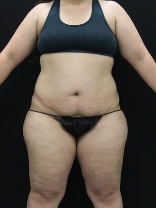 Liposuction: Case 48 - Before