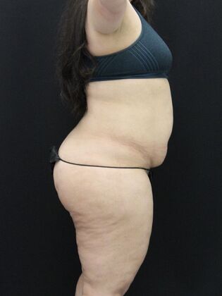 Liposuction: Case 48 - Before