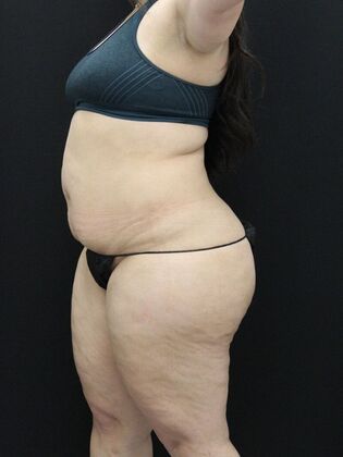 Liposuction: Case 48 - Before