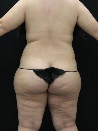 Liposuction Case 48 - Before