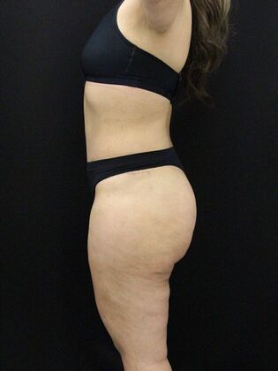 Liposuction: Case 48 - After