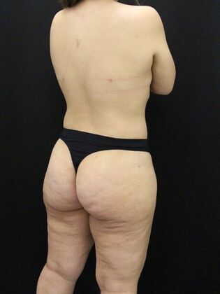 Liposuction: Case 48 - After