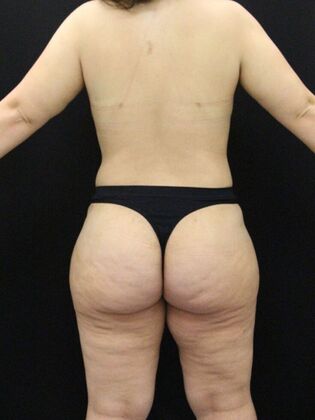 Liposuction Case 48 - After