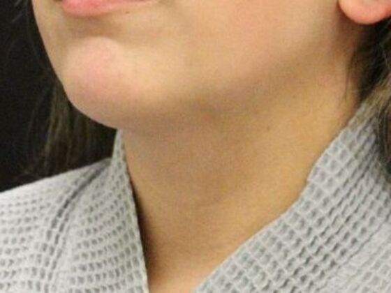 Liposuction: Case 49 - After